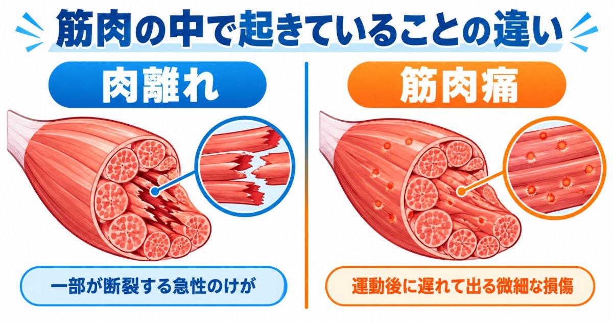 肉離れと筋肉痛は体の中で起きていることがまったく違う